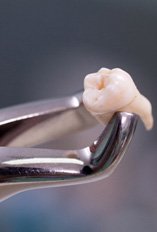 Dental forceps holding a patient’s extracted tooth