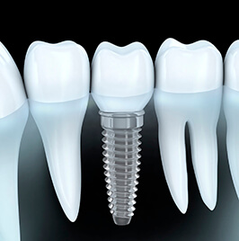 digital dental implants model