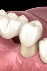 diagram of a dental bridge