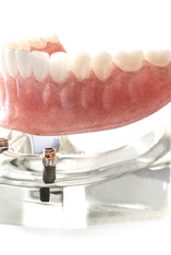 Model of a lower implant denture