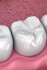 Model of tooth-colored filling on molar