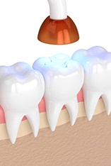 Dental light hardening composite resin