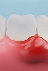 Inflamed gums