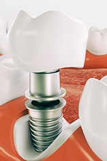 Diagram highlighting components of a dental implant in Park Slope