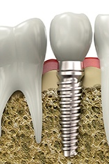 Diagram of an integrated dental implant in Park Slope