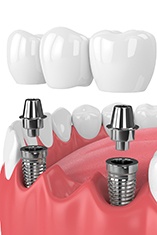 Diagram of an implant bridge and its components