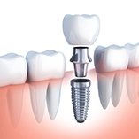 Diagram of a dental implant in Park Slope