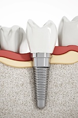 3D illustration of a dental implants and surrounding teeth