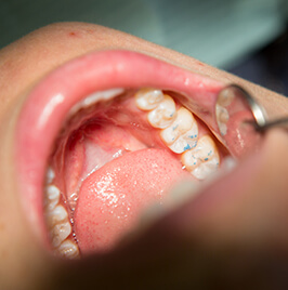 dentist checking patient's teeth with dental mirror