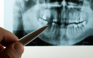 hand of dentist reviewing x-rays