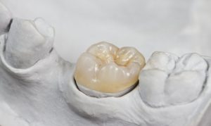 A dental crown sitting in a dental model.