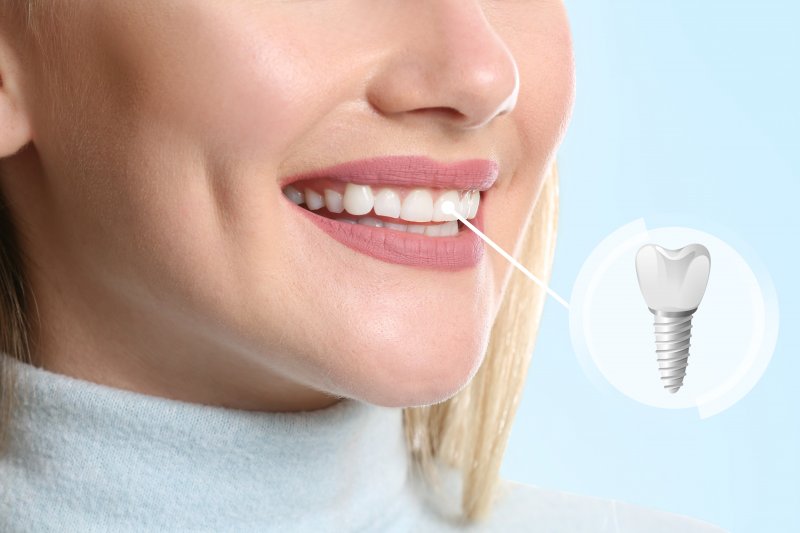 Woman in turtleneck smiling showing teeth with model of dental implant floating in a white circle on blue background